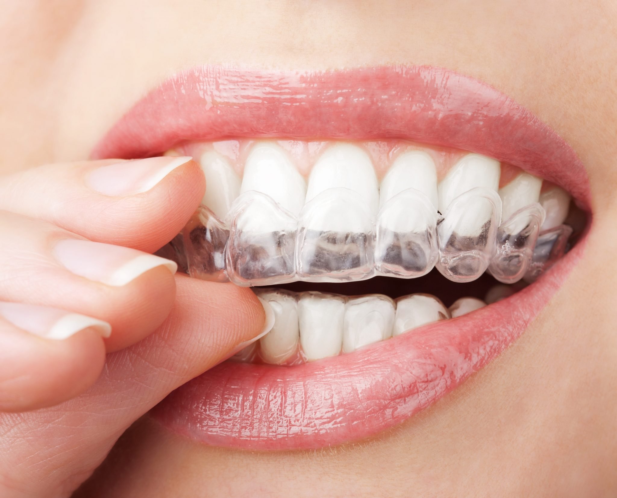 Cosmetic Dentistry - Bright Teeth | Kaizen Dental