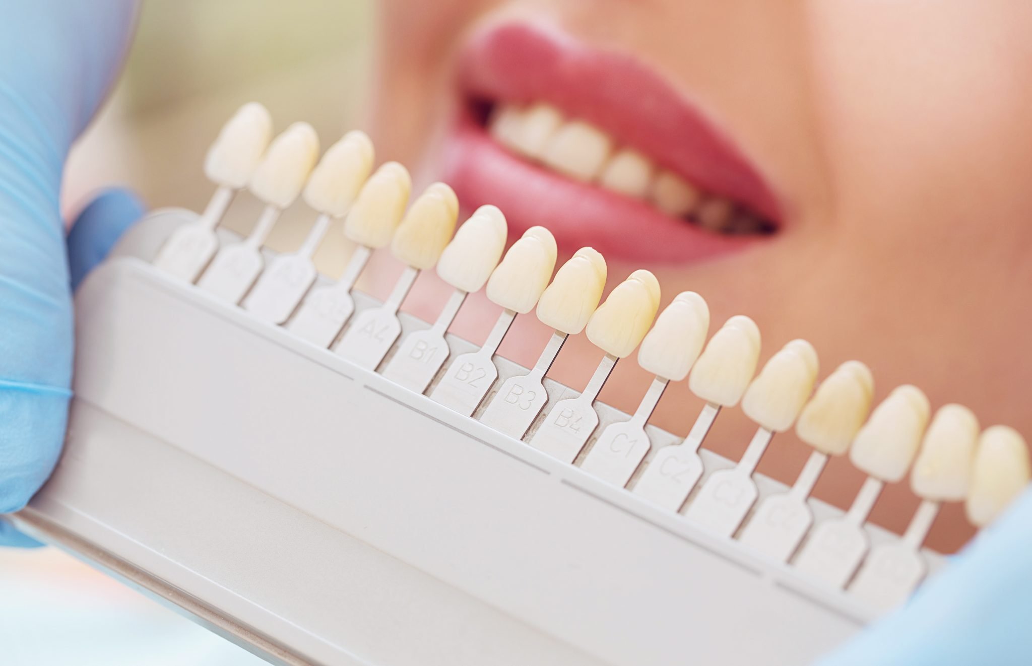 Caring for Dental Implants - Richmond Dentist | Kaizen Dental