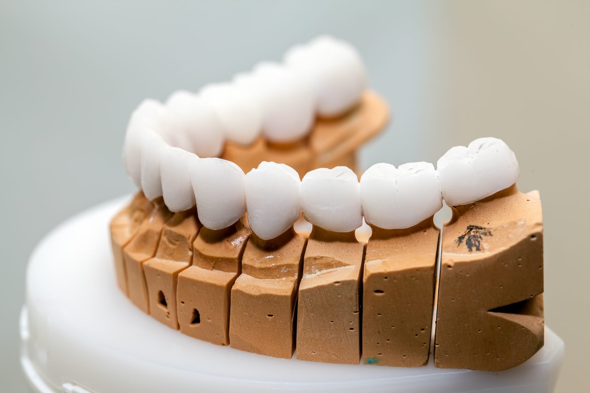 Differences Implants, Bridges, Dentures | Kaizen Dental