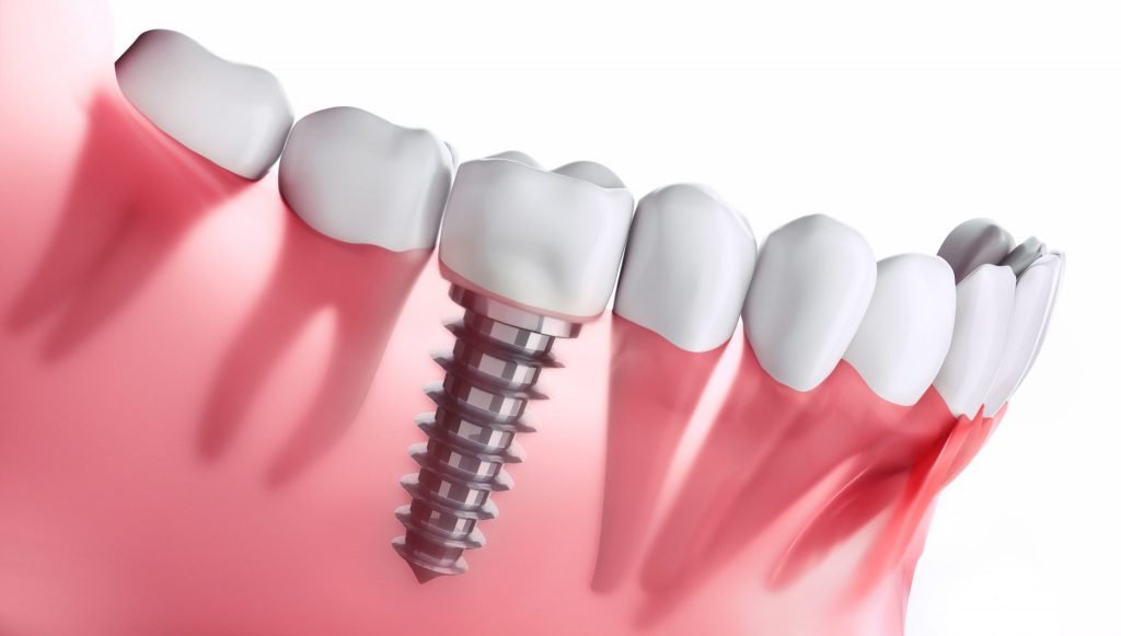 Fix Gaps in Teeth - Dental Implants | Kaizen Dental